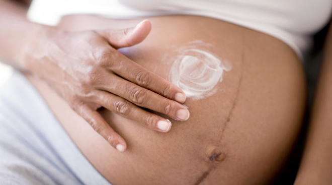 Stretch Marks: How To Prevent Them