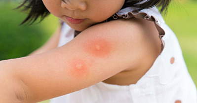 Ways to Prevent & Treat Mosquito Bites in Children